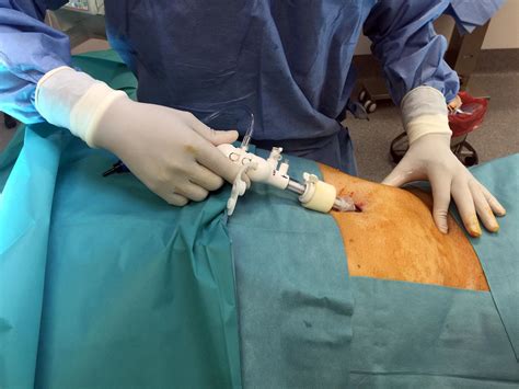 hernia inguinal bilateral por laparoscopia
